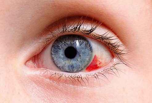 See your eye doctor as soon as possible if anything happens to your eyes.