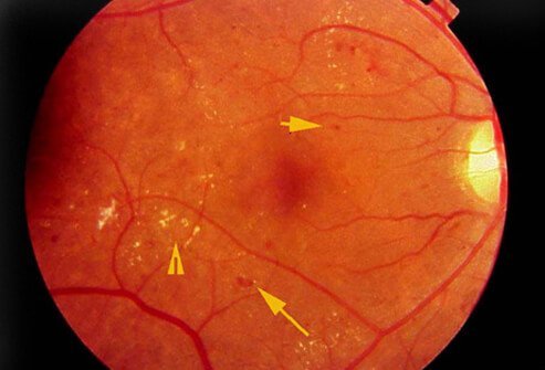 Diabetic Retinopathy