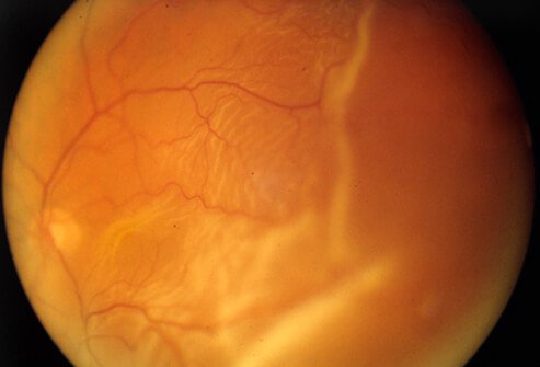 Picture of Retinal Detachment