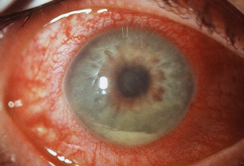 Picture of Uveitis