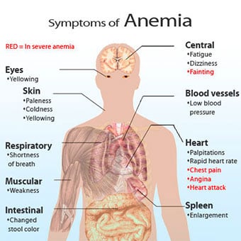 Illustration showing the symptoms of anemia.