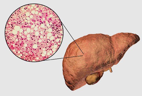 The exact cause of liver cancer is not known. Researchers have revealed that liver cancer occurs when the cells in the liver grow uncontrollably because of an abnormal change in their genetic material (mutation).