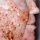 Actinic Keratosis