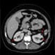 Kidney Angiomyolipoma