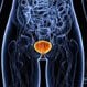 Bladder Infection (Cystitis)