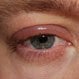 Blepharitis