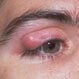 What Is the Fastest Way to Get Rid of a Chalazion?