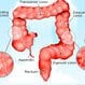 Colon Cancer