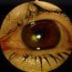 Corneal Ulcer