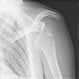 Dislocated Shoulder