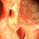 What Are the Symptoms of a Diverticulitis Flare-Up?