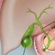 Gallbladder Cancer