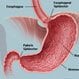 What Is Gastritis? Symptoms, Treatment, and Diet