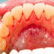 Is Gingivitis Contagious?