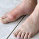 Gout (Gouty Arthritis)