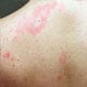 Are Hives and Rash the Same Thing?