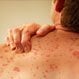 Are Hives (Urticaria) Contagious?