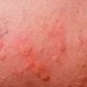 Hives (Urticaria)