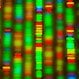 Hunter Syndrome (Mucopolysaccharidosis II, MPS II)