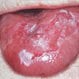 Leukoplakia