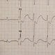 Low Potassium (Hypokalemia)