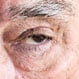 What Is the Best Treatment for Macular Edema?