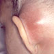 What Are the Symptoms of a Mastoid Infection?