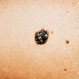 Melanoma