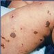 Meningococcemia (Meningococcal Disease)