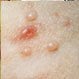 Molluscum Contagiosum