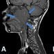 Nasopharyngeal Cancer