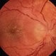 Optic Neuritis