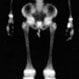 Osteomyelitis