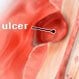 Peptic Ulcer (Stomach Ulcer)