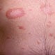 Pityriasis Rosea