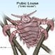 Pubic Lice (Crabs)