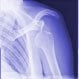 Rotator Cuff Tear and Injury