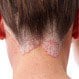 Scalp Psoriasis (Psoriasis of the Scalp)