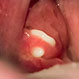 How Do You Get Rid of Tonsil Stones?