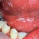 Thrush (Oral Candidiasis)