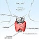 Hyperthyroidism