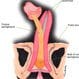 Urethral Stricture