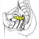 Uterine Cancer