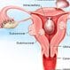 Uterine Fibroids (Benign Tumors of the Uterus)