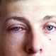 What Are Some Common Eye Infections?