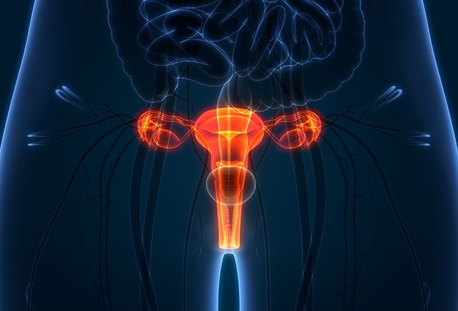 MRKH syndrome