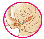 Put a finger into your vagina and hook it through the ring - Illustration