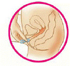 Place the tip of the ring in the vaginal opening - Illustration