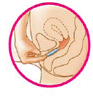 Use your index finger to push the ring as far as you can into your vagina - Illustration