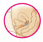 Femring should now be in your upper vagina - Illustration